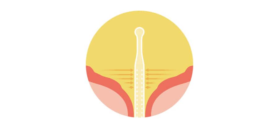 Diagram van een Luja-sonde in de blaas. De Micro-hole Zone Technology van Luja is ontworpen om urine vanuit de bodem van de blaas af te voeren en een ononderbroken, vrije urinestroom mogelijk te maken 